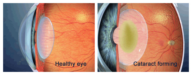 CATARACT CLEAR EYE & CLOUDY LENS